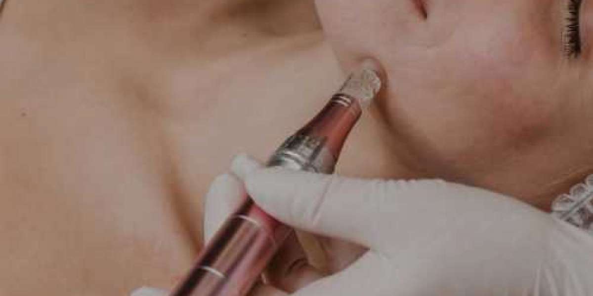 Microneedling Vaughan: A Complete Guide to Smoother, Healthier-Looking Skin