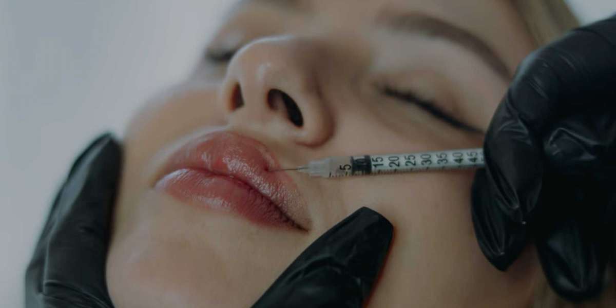 Lip Filler Vaughan: A Complete Guide to Natural, Fuller Lips